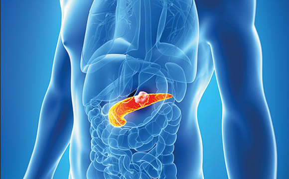 Pankreas Kanserleri