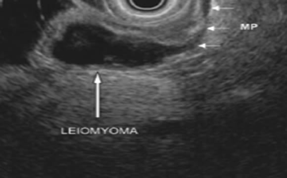 Tümör, Lenf Nodu ve Metastaz