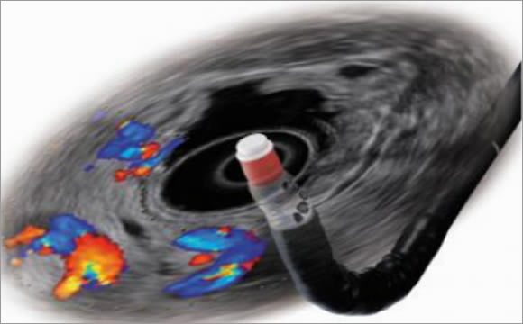 Endoskopik Ultrason Nedir?
